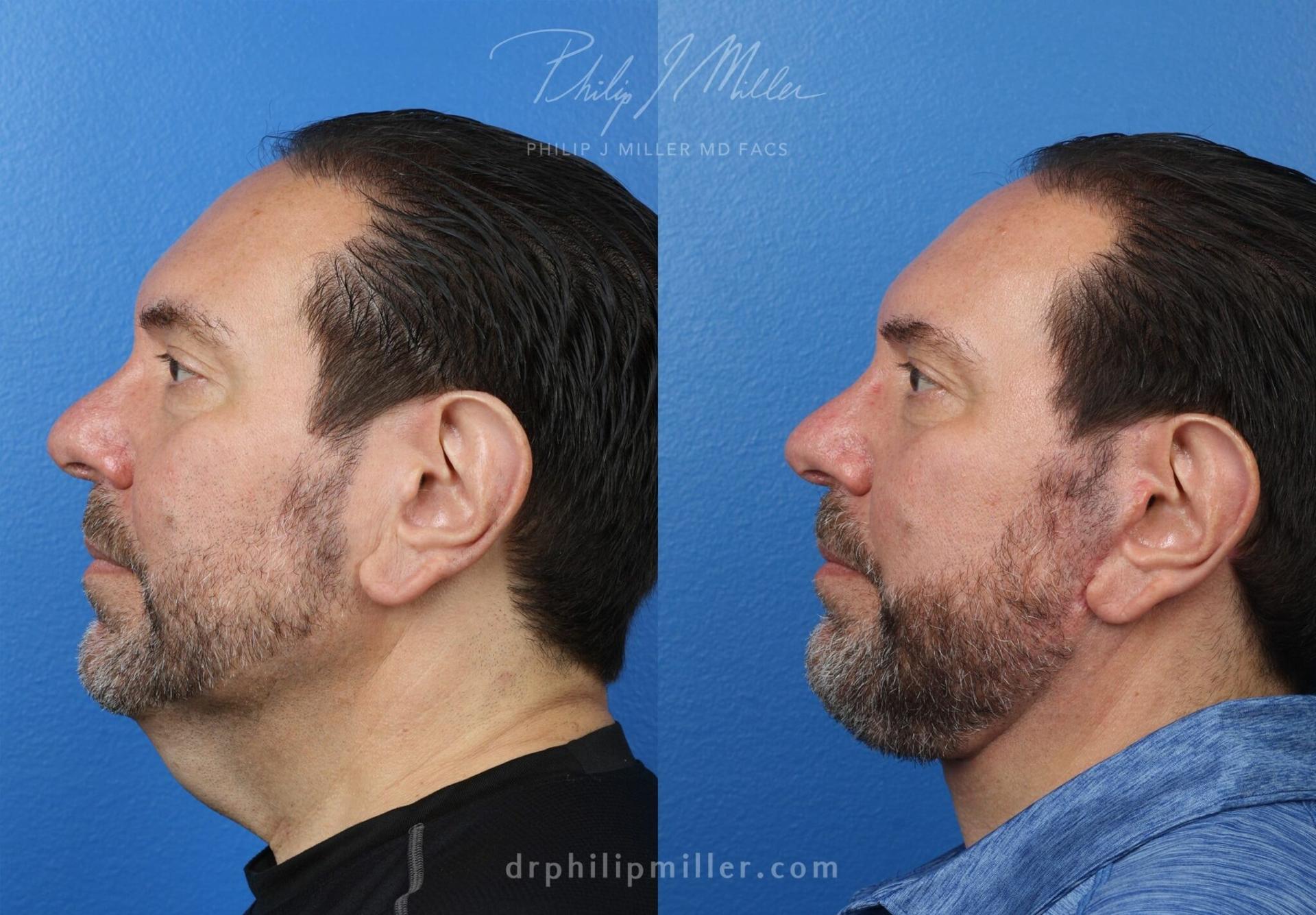 Philip Miller, MD facelift result — New York, NY