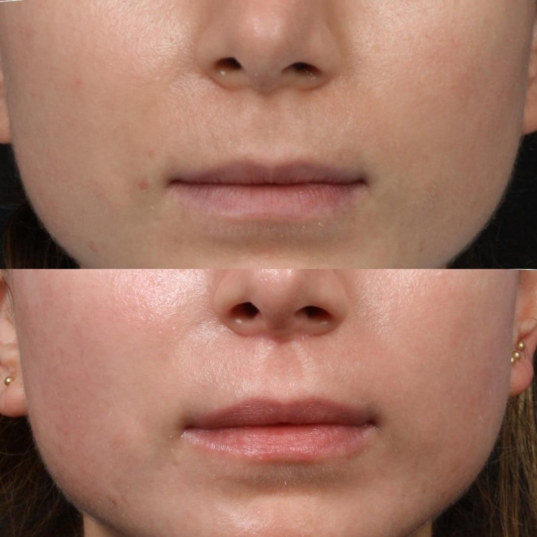 Philip Miller, MD lip lift result — New York, NY
