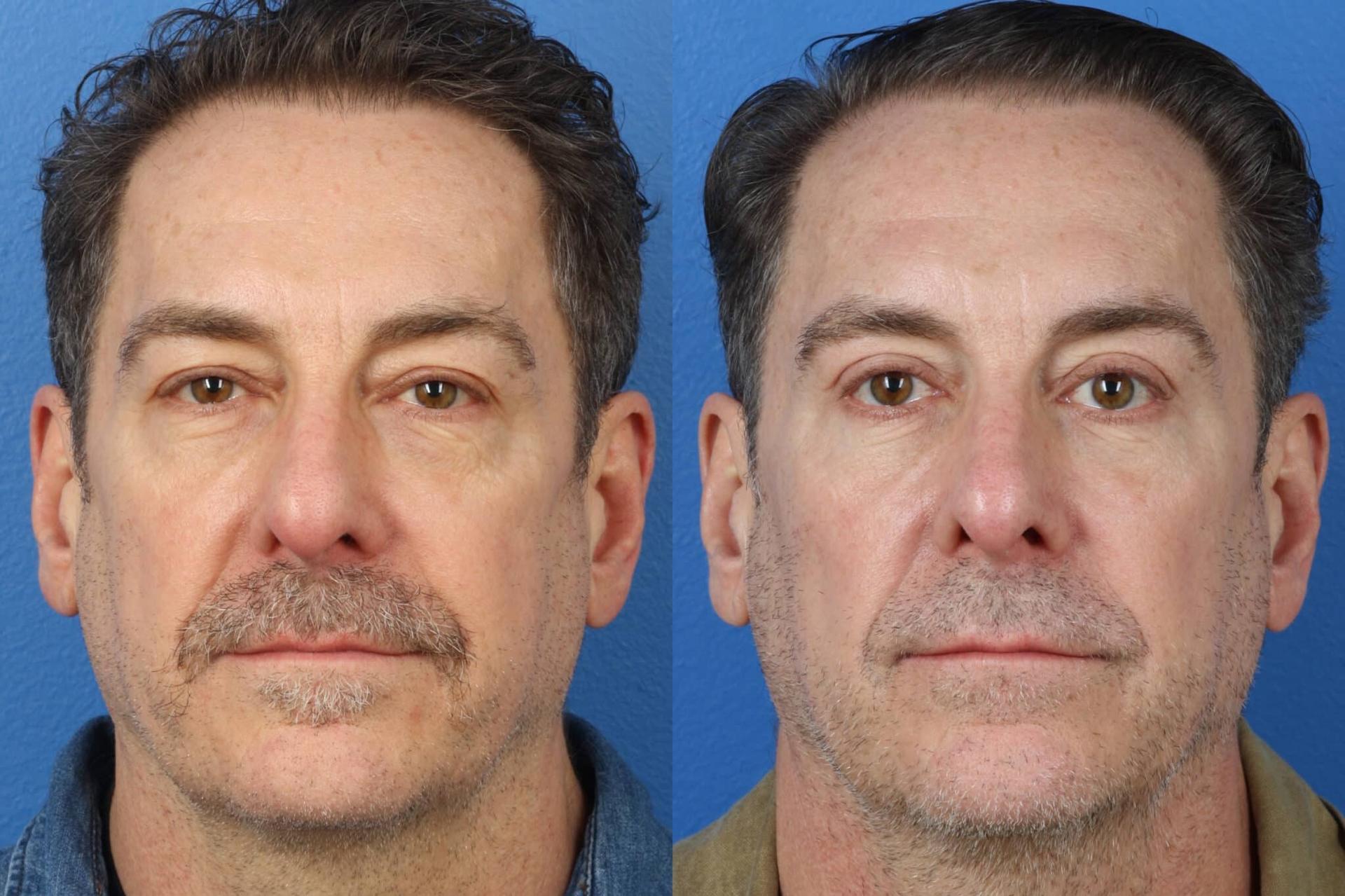 Philip Miller, MD eyelid lift result — New York, NY