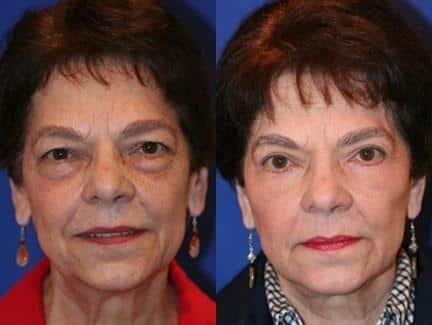 Philip Miller, MD facelift result — New York, NY