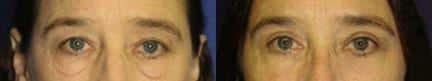 Philip Miller, MD eyelid lift result — New York, NY