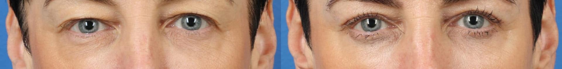 Philip Miller, MD eyelid lift result — New York, NY