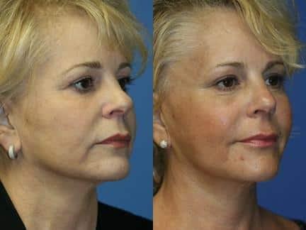 Philip Miller, MD facelift result — New York, NY