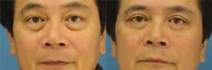 Philip Miller, MD eyelid lift result — New York, NY