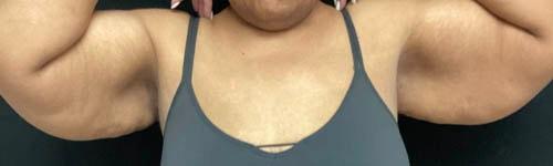 Arm Lift before at Ogilvie Plastic Surgery in Chicago, IL