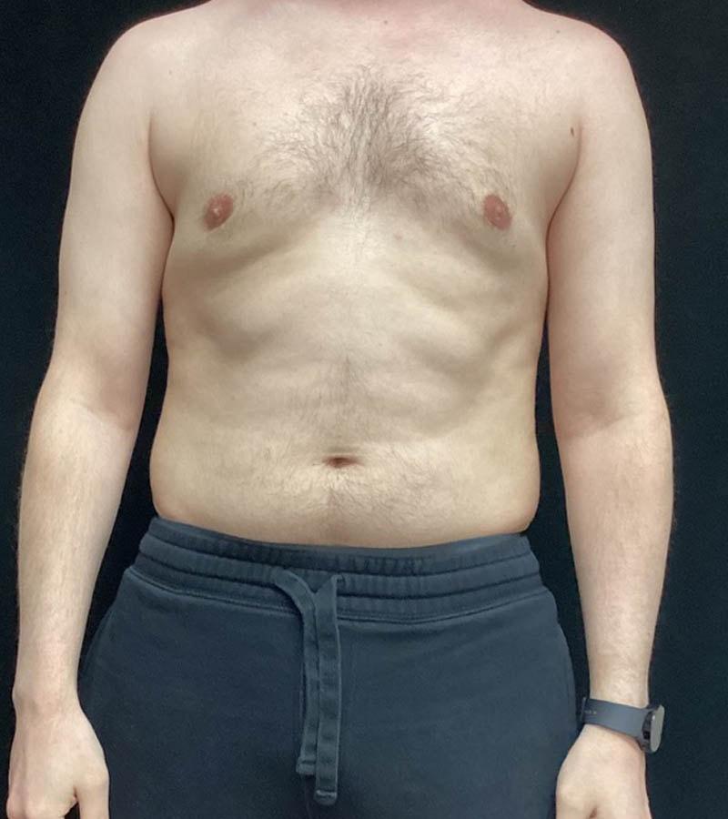 Ogilvie Plastic Surgery gynecomastia after — Chicago, IL