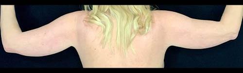 Arm Lift before at Ogilvie Plastic Surgery in Chicago, IL