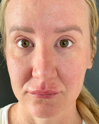 Ogilvie Plastic Surgery eyelid lift after — Chicago, IL