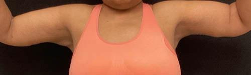 Arm Lift after at Ogilvie Plastic Surgery in Chicago, IL
