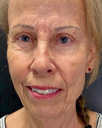 Ogilvie Plastic Surgery eyelid lift after — Chicago, IL