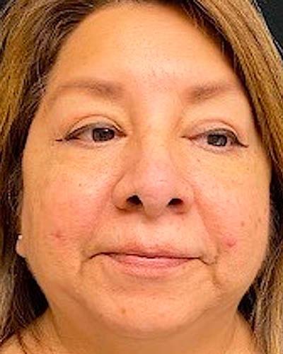 Ogilvie Plastic Surgery eyelid lift after — Chicago, IL