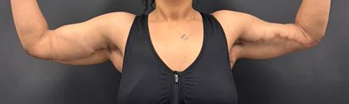 Arm Lift after at Ogilvie Plastic Surgery in Chicago, IL