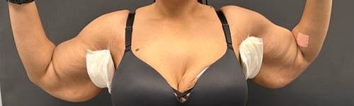 Arm Lift before at Ogilvie Plastic Surgery in Chicago, IL