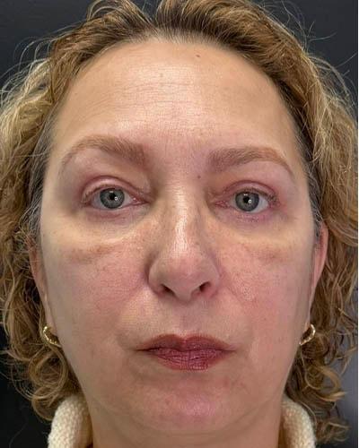 Ogilvie Plastic Surgery eyelid lift after — Chicago, IL