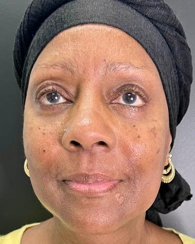 Ogilvie Plastic Surgery eyelid lift after — Chicago, IL