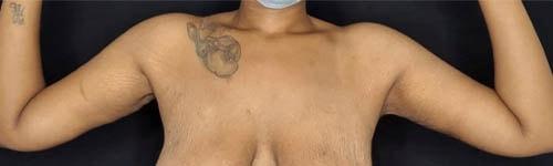 Arm Lift after at Ogilvie Plastic Surgery in Chicago, IL