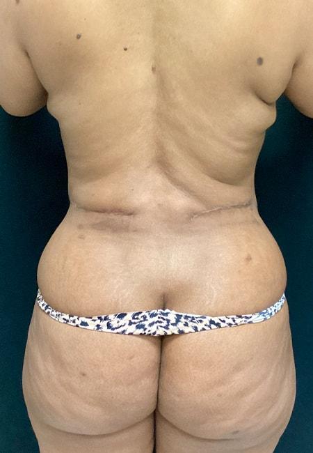 Ogilvie Plastic Surgery body contouring after — Chicago, IL