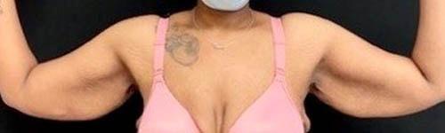 Arm Lift before at Ogilvie Plastic Surgery in Chicago, IL