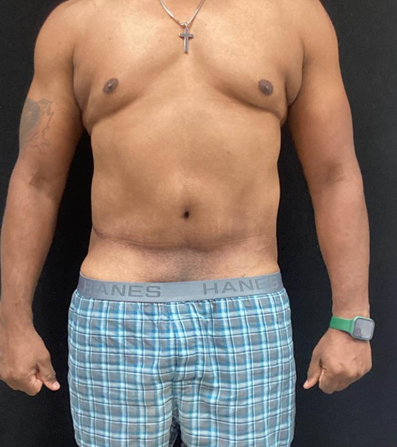 Ogilvie Plastic Surgery gynecomastia after — Chicago, IL
