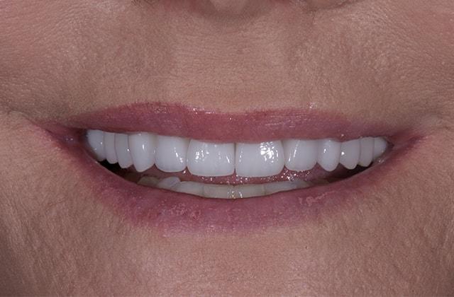 Libby Dental veneers after — San Diego, CA