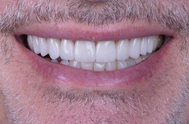 Libby Dental veneers after — San Diego, CA