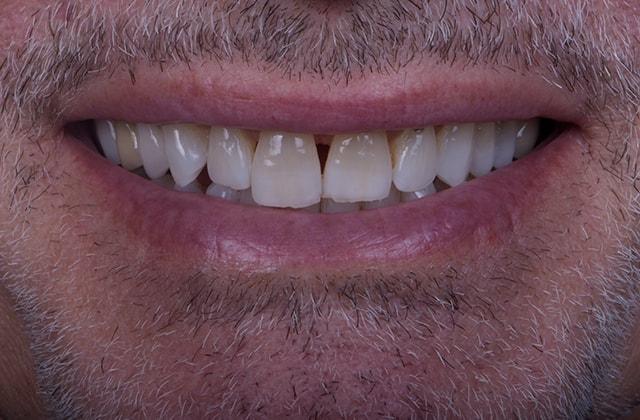 Dental Veneers before at Libby Dental in San Diego, CA