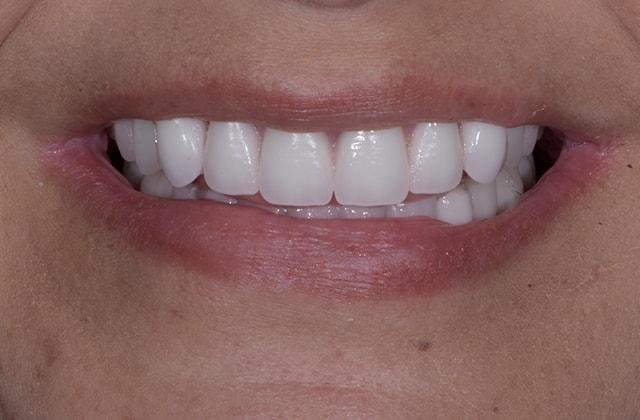 Libby Dental smile makeover after — San Diego, CA