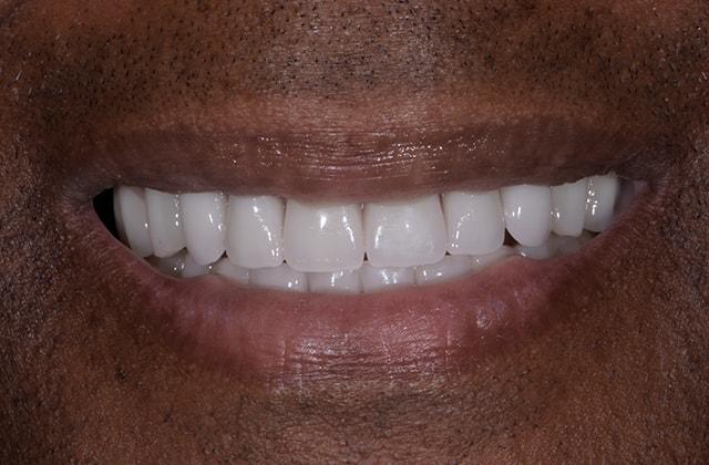 Libby Dental smile makeover after — San Diego, CA