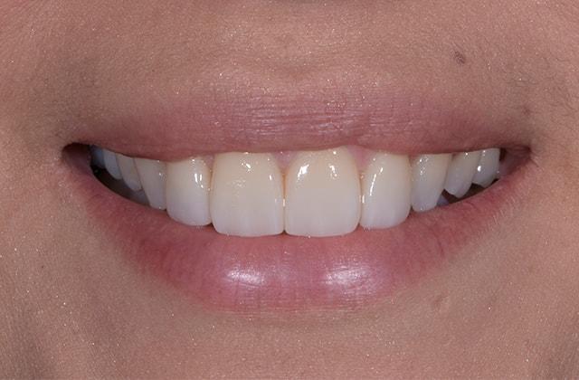 Libby Dental veneers after — San Diego, CA