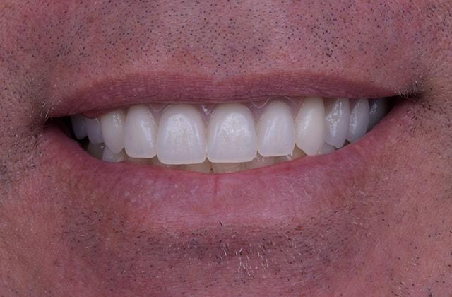 Libby Dental smile makeover after — San Diego, CA