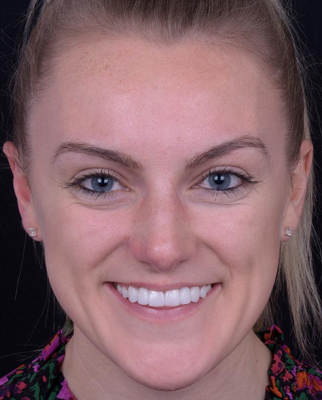 Libby Dental smile makeover after — San Diego, CA