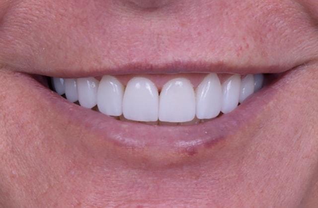 Libby Dental veneers after — San Diego, CA