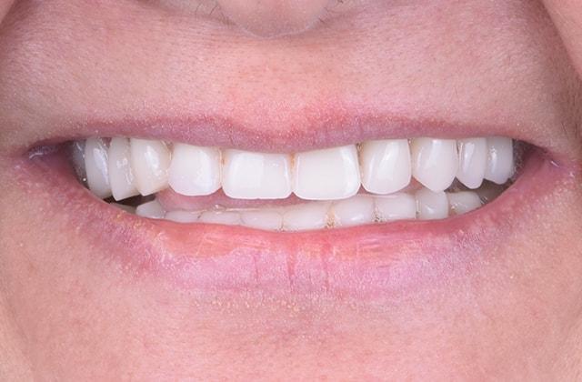 Smile Makeover after at Libby Dental in San Diego, CA