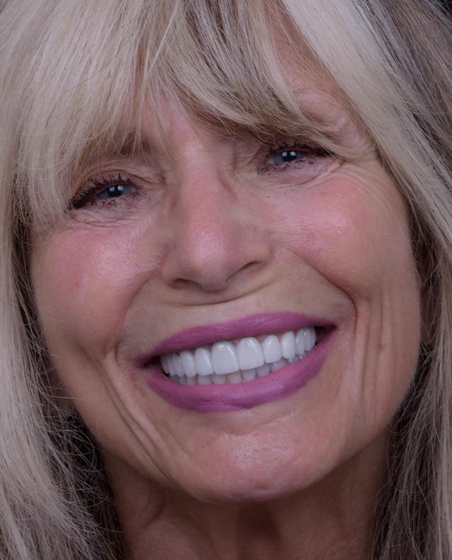 Libby Dental smile makeover after — San Diego, CA