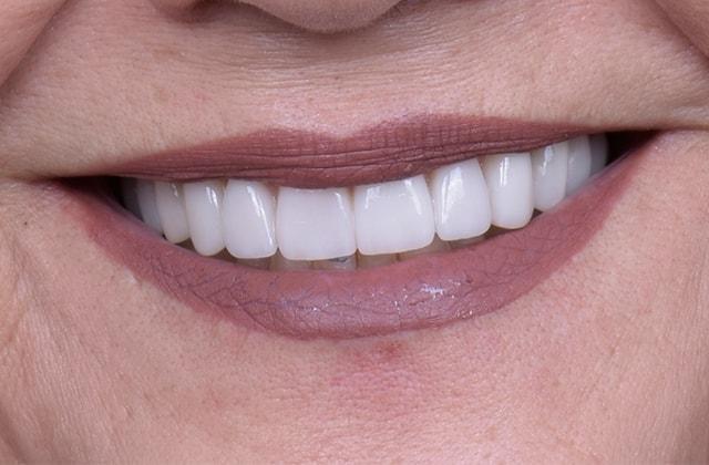 Libby Dental veneers after — San Diego, CA