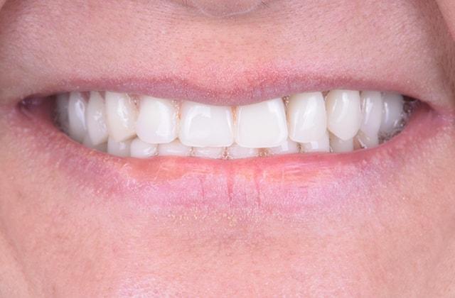 Smile Makeover before at Libby Dental in San Diego, CA