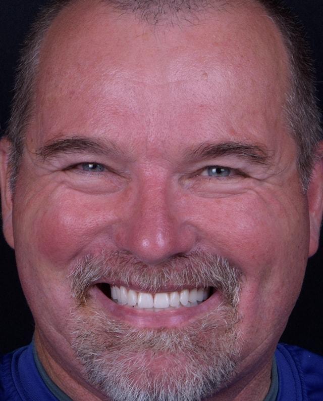 Libby Dental smile makeover after — San Diego, CA