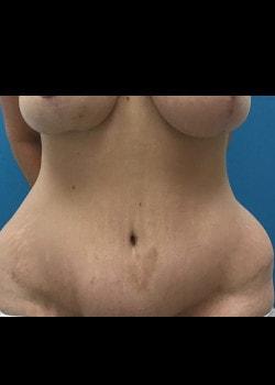 Banerji Plastic Surgery tummy tuck after — Webster, TX