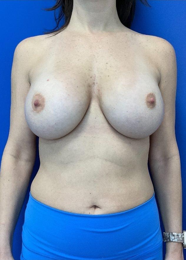 Banerji Plastic Surgery breast augmentation after — Webster, TX