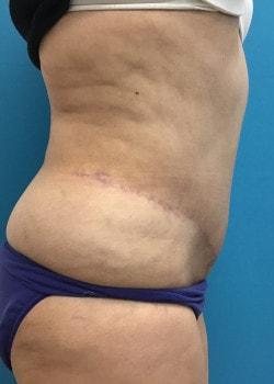 Banerji Plastic Surgery tummy tuck after — Webster, TX