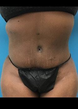 Banerji Plastic Surgery tummy tuck after — Webster, TX
