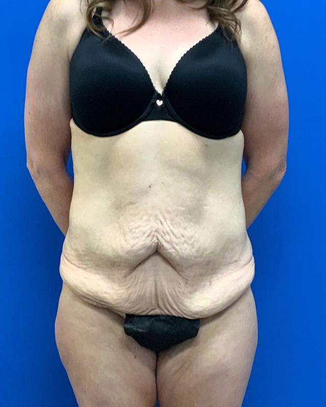 Tummy Tuck before at Athēnix | Advanced Plastic Surgery & Aesthetic Centers in Irvine, CA