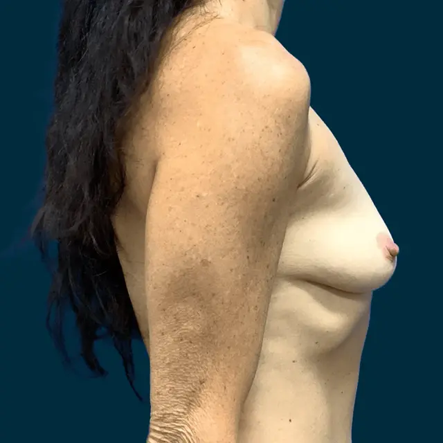 Breast Augmentation before at Athēnix | Advanced Plastic Surgery & Aesthetic Centers in Irvine, CA