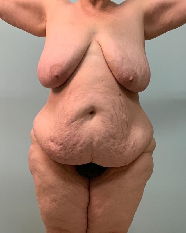 Mommy Makeover before at Athēnix | Advanced Plastic Surgery & Aesthetic Centers in Irvine, CA
