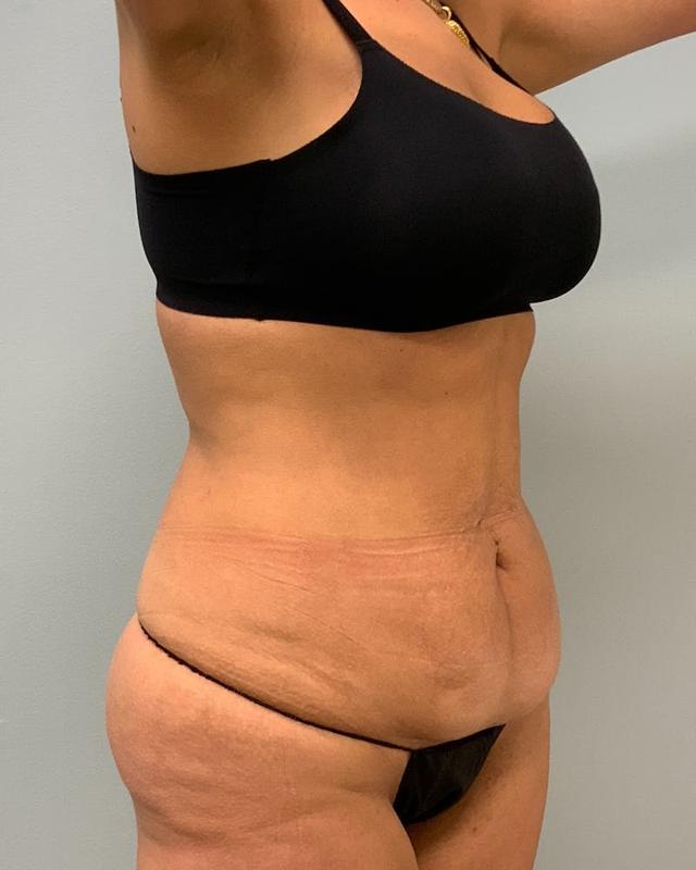 Tummy Tuck before at Athēnix | Advanced Plastic Surgery & Aesthetic Centers in Irvine, CA