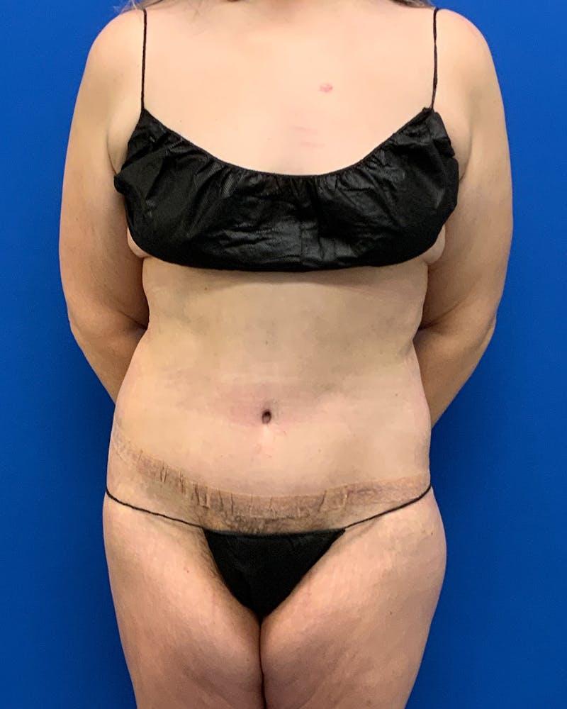 Athēnix | Advanced Plastic Surgery & Aesthetic Centers tummy tuck after — Irvine, CA