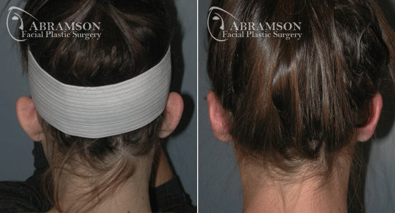 Peter Jay Abramson, MD - Abramson Facial Plastic Surgery & Rejuvenation Center otoplasty result — Sandy Springs, GA