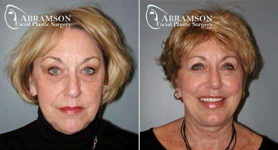 Peter Jay Abramson, MD - Abramson Facial Plastic Surgery & Rejuvenation Center neck lift result — Sandy Springs, GA