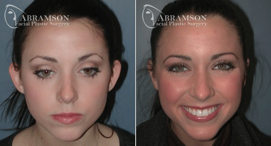 Peter Jay Abramson, MD - Abramson Facial Plastic Surgery & Rejuvenation Center otoplasty result — Sandy Springs, GA