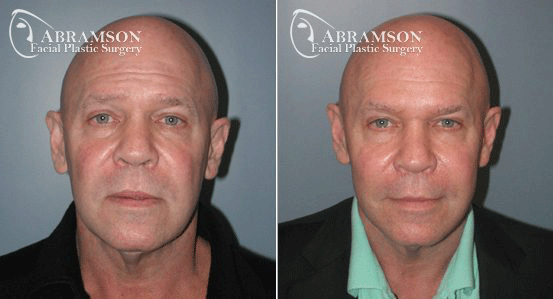 Facelift result at Peter Jay Abramson, MD - Abramson Facial Plastic Surgery & Rejuvenation Center in Sandy Springs, GA